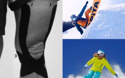 Does your balance get worse when you are fatigued from skiing?  Kinesiology tape might help you on the slopes this year.