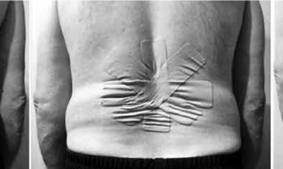 Different taping techniques for persistent low back pain-does it matter how you tape?