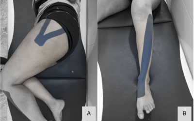 Use of kinesiology taping to assist with dynamic knee control in female athletes.