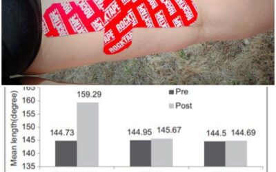 Kinesiology tape can have an immediate effect on hamstring flexibility.