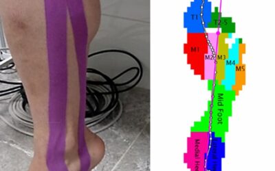 Got “Shin splints”? Kinesiology tape might help.