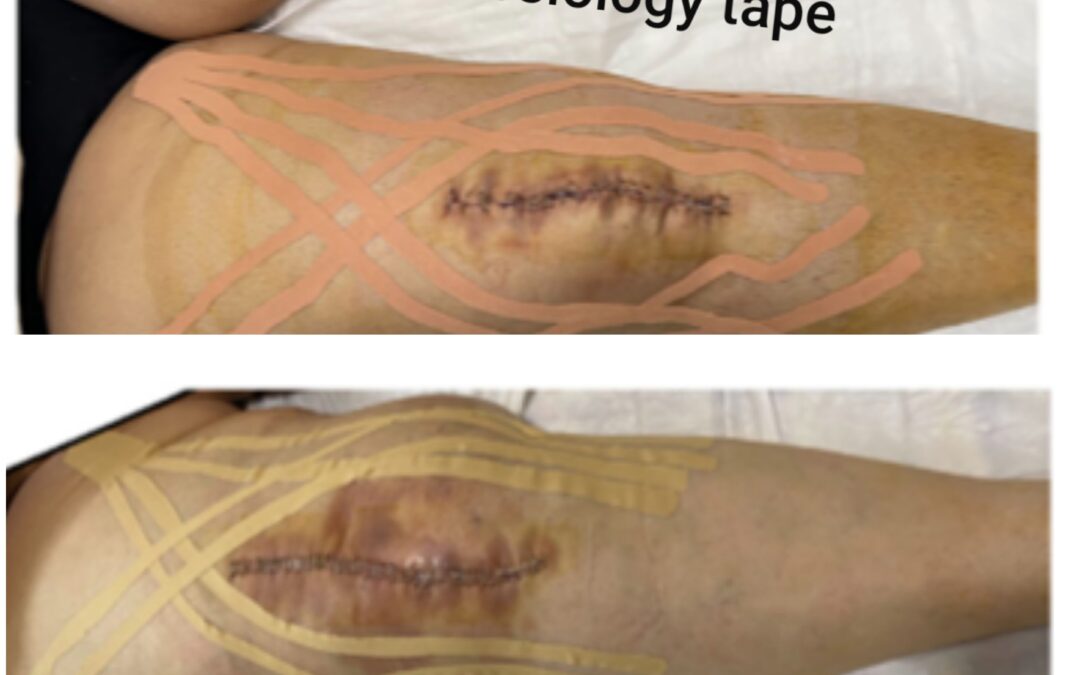 Kinesiology tape helps with post-operative swelling after knee replacement surgery.