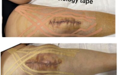 Kinesiology tape helps with post-operative swelling after knee replacement surgery.